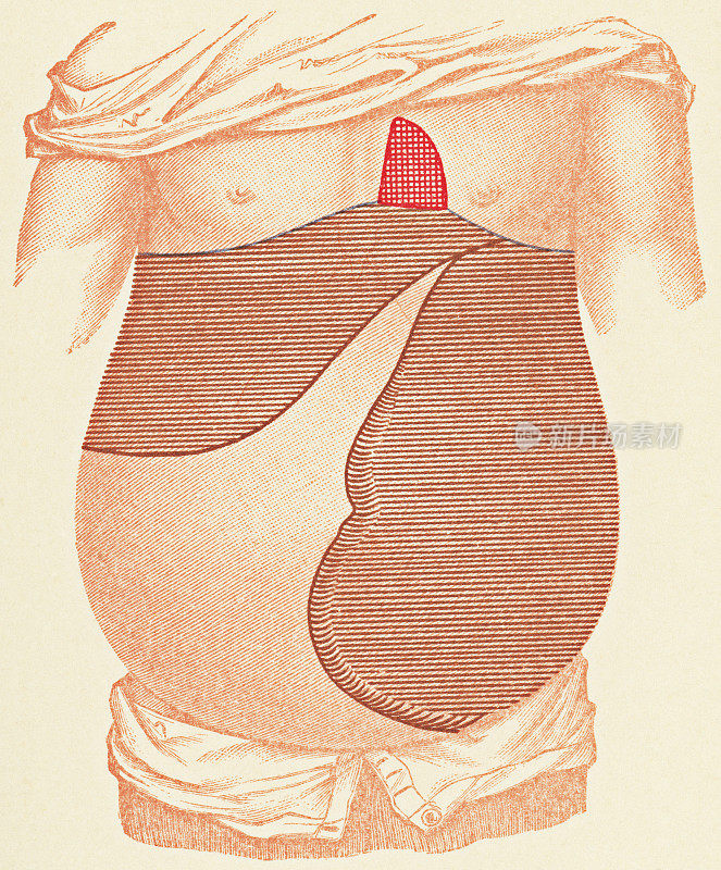 一个白血病病人的打击乐考试点的人体躯干的医学插图，正面视图- 19世纪